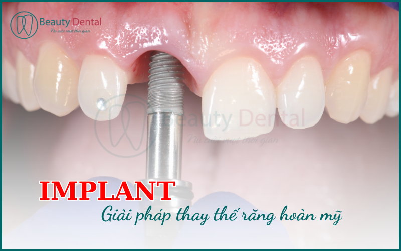 Răng Implant tồn tại bền lâu, đảm bảo chức năng ăn nhai như răng thật