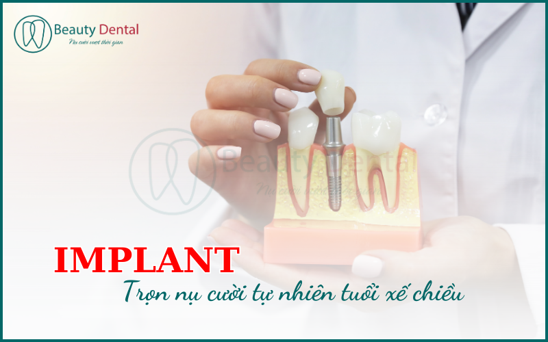 Cấy Implant - phương pháp hiện đại, tối ưu cho vấn đề mất răng ở người cao tuổi