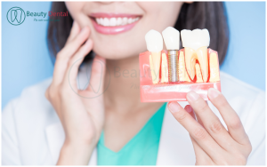 Cấy răng Implant có đau không?