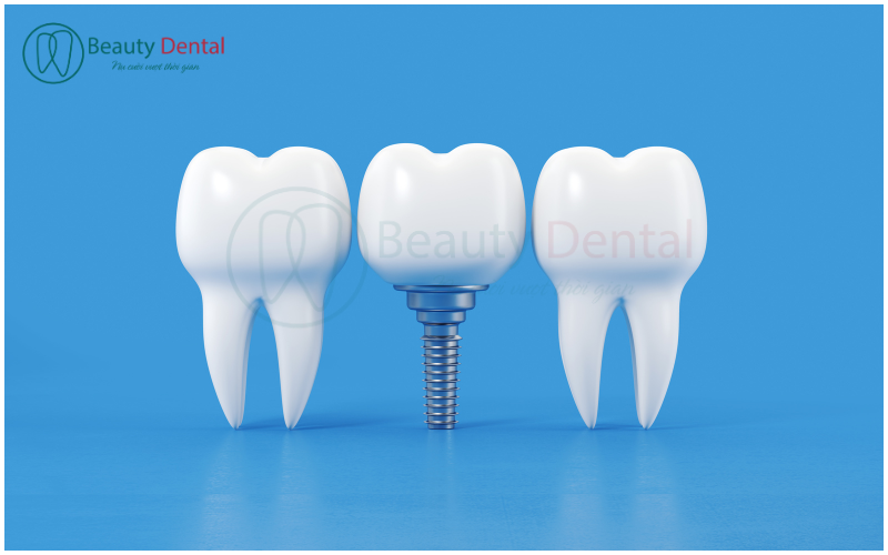 Implant nha khoa đã trở thành một cuộc cách mạng trong lĩnh vực nha khoa. Có rất nhiều người hối hận khi trồng implant - hối hận vì không biết đến sớm hơn