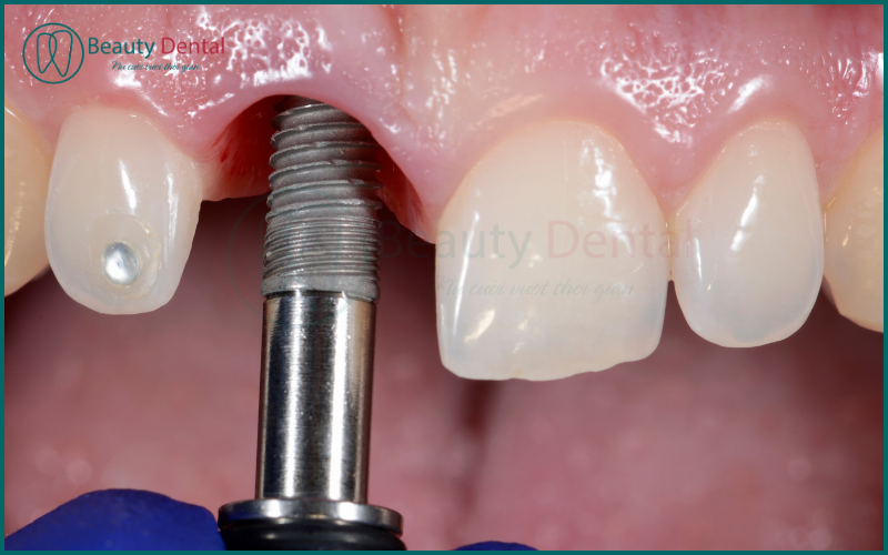 Implant giúp bạn ăn nhai tốt hơn, từ đó cải thiện tiêu hóa và sức khỏe tổng thể