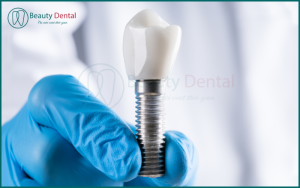 Hối hận khi trồng Implant