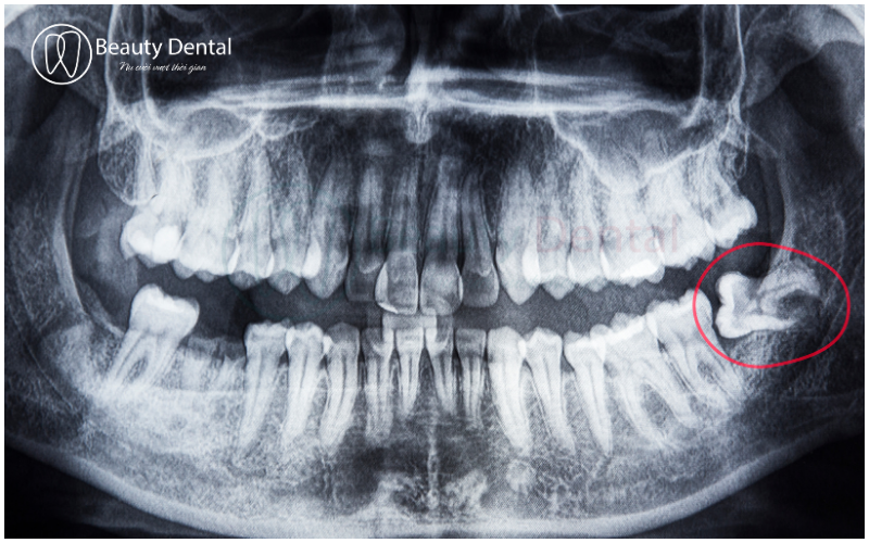 Phim Xquang trước khi nhổ răng khôn sẽ giúp bác sĩ phán đoán hướng điều trị cho bạn thuận lợi hơn