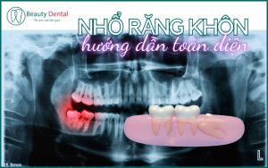 Nhổ răng khôn - Hướng dẫn toàn diện