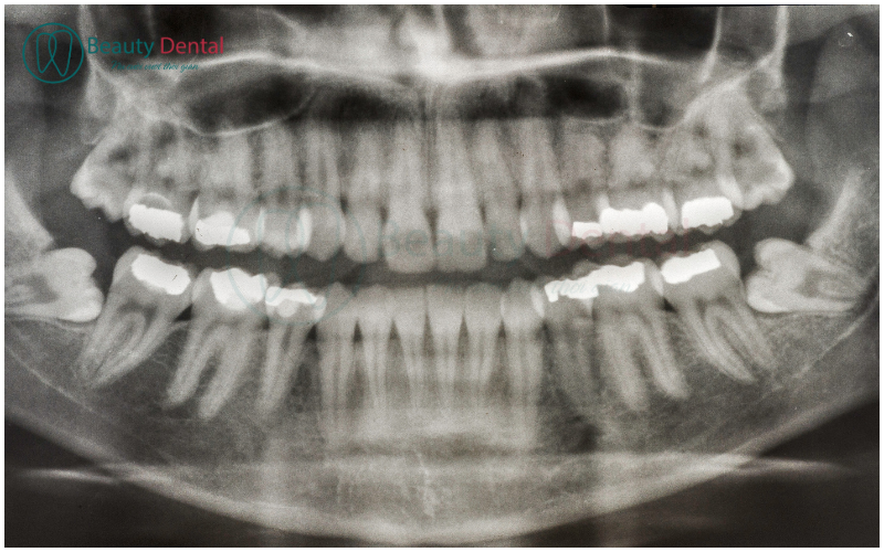 Cần chụp phim X-quang để thấy rõ chi tiết và phương hướng phát triển của răng