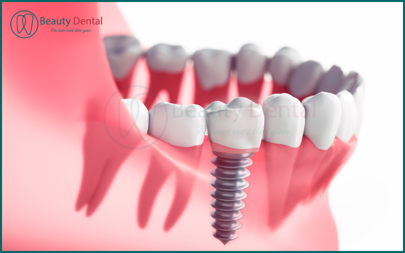 Implant mang lại kết quả tự nhiên và bền vững nhất trong các giải pháp phục hình răng hiện nay